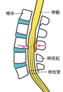 脊柱管狭窄症